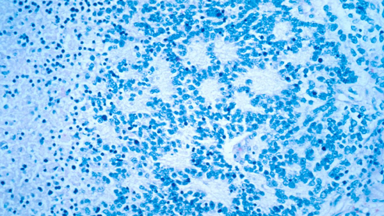 New Drug Combination Can Cure Mouse Models of Neuroblastoma