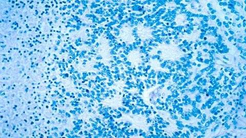 New Drug Combination Can Cure Mouse Models of Neuroblastoma