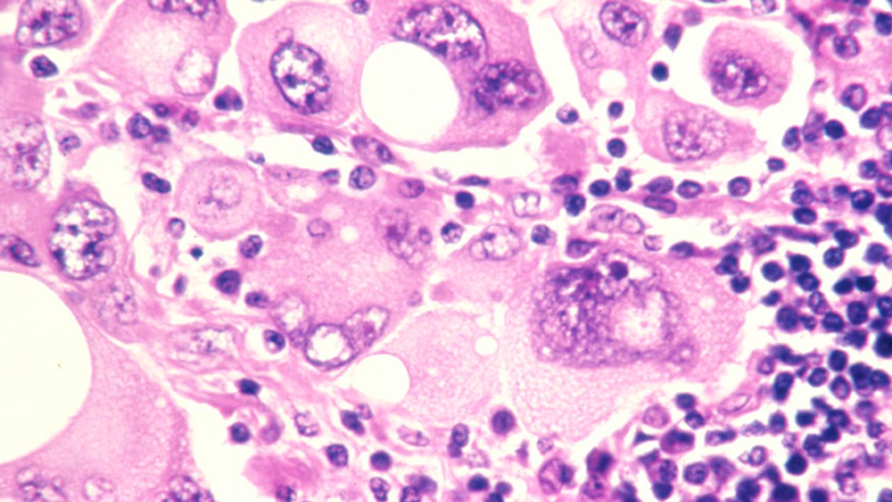 Identifying High-Risk Melanoma Patients Suitable for Additional Therapy