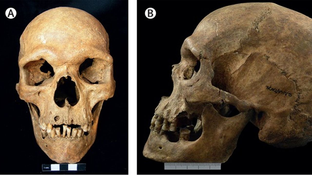 Oldest Case of Klinefelter Syndrome Diagnosed in Ancient Skeleton