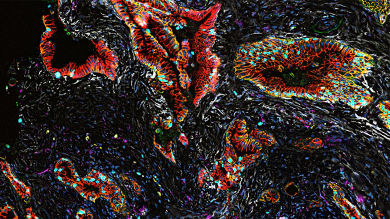 Human Pancreatic Tumor