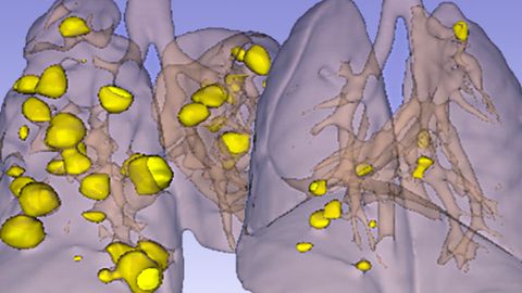 Drug Combination Halts Tumor Growth and Resistance in Mice