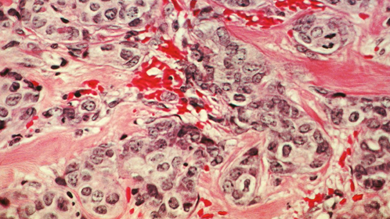 New Metabolic Biomarkers Predict Outcomes for Breast Cancer Patients
