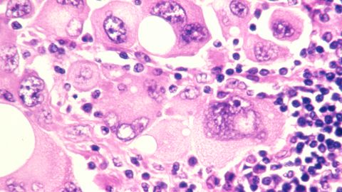 Antibiotics May Increase Melanoma Growth in Bones by Depleting the Microbiome