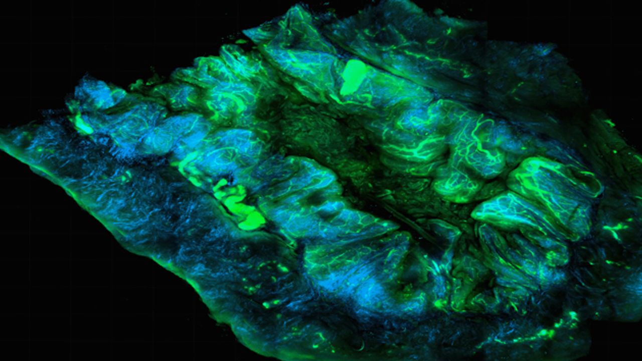 mRNA Therapy for Ovarian Cancer Delivers Positive Results in Mice