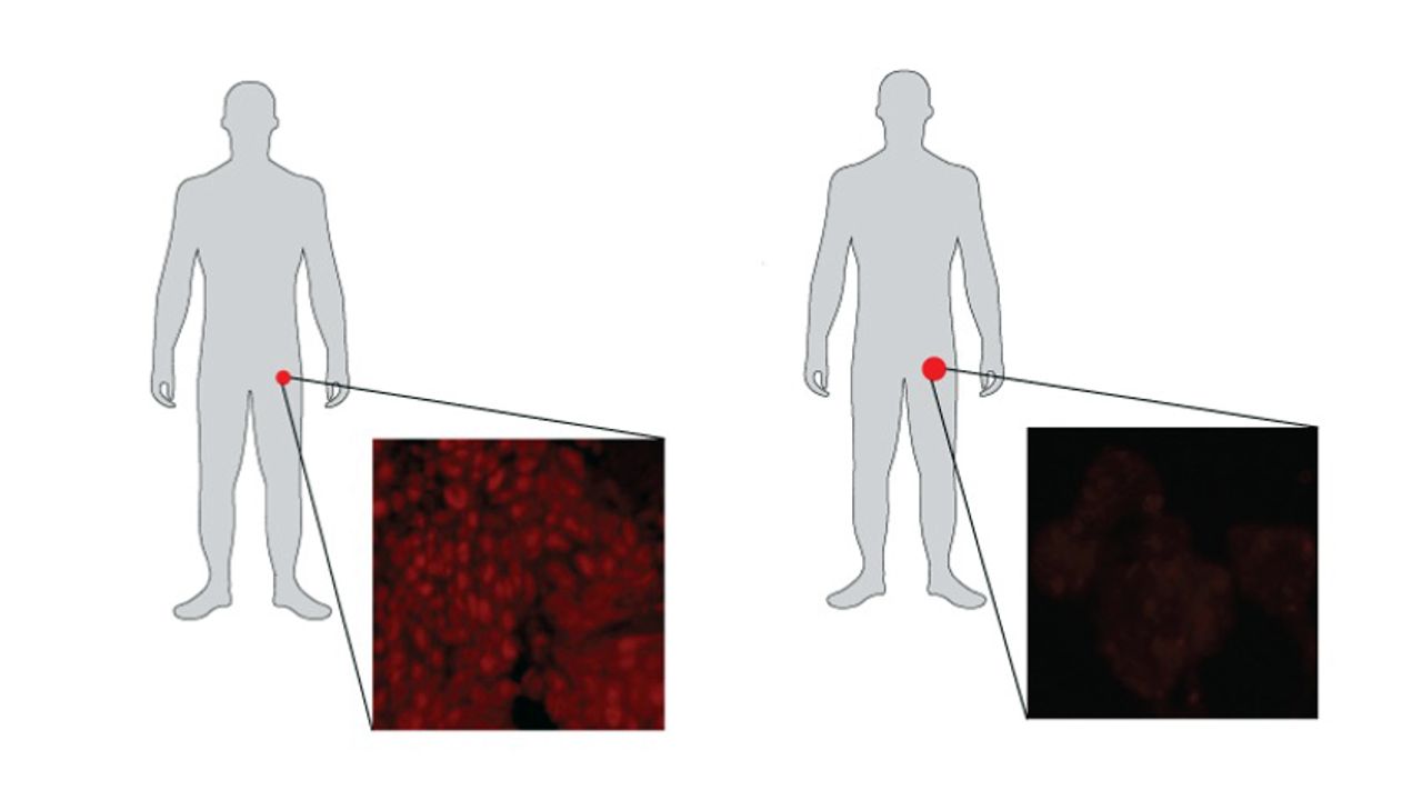 Common Prostate Cancer Treatment May Rewire the "Engine" Driving Tumors