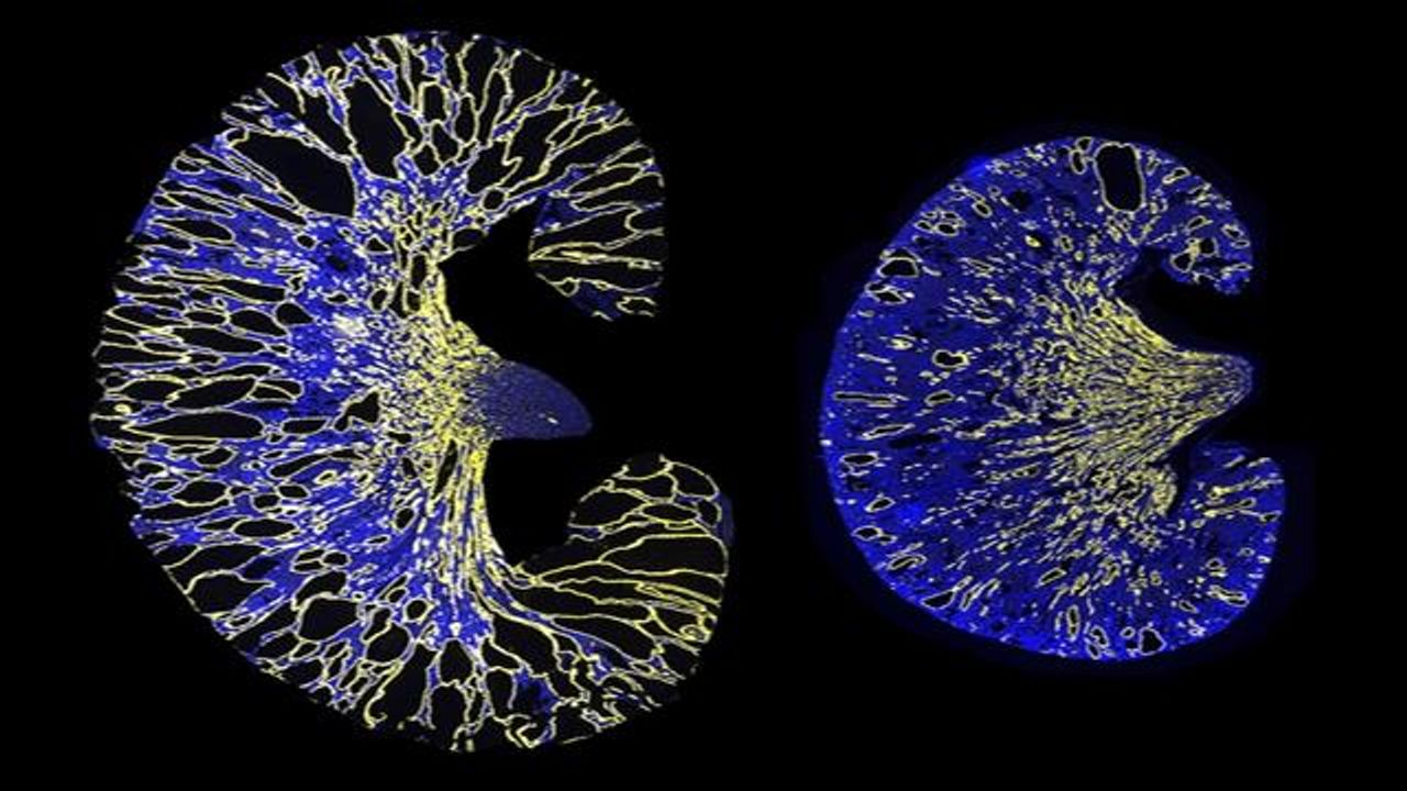 Gene Therapy Target for Polycystic Kidney Disease Discovered