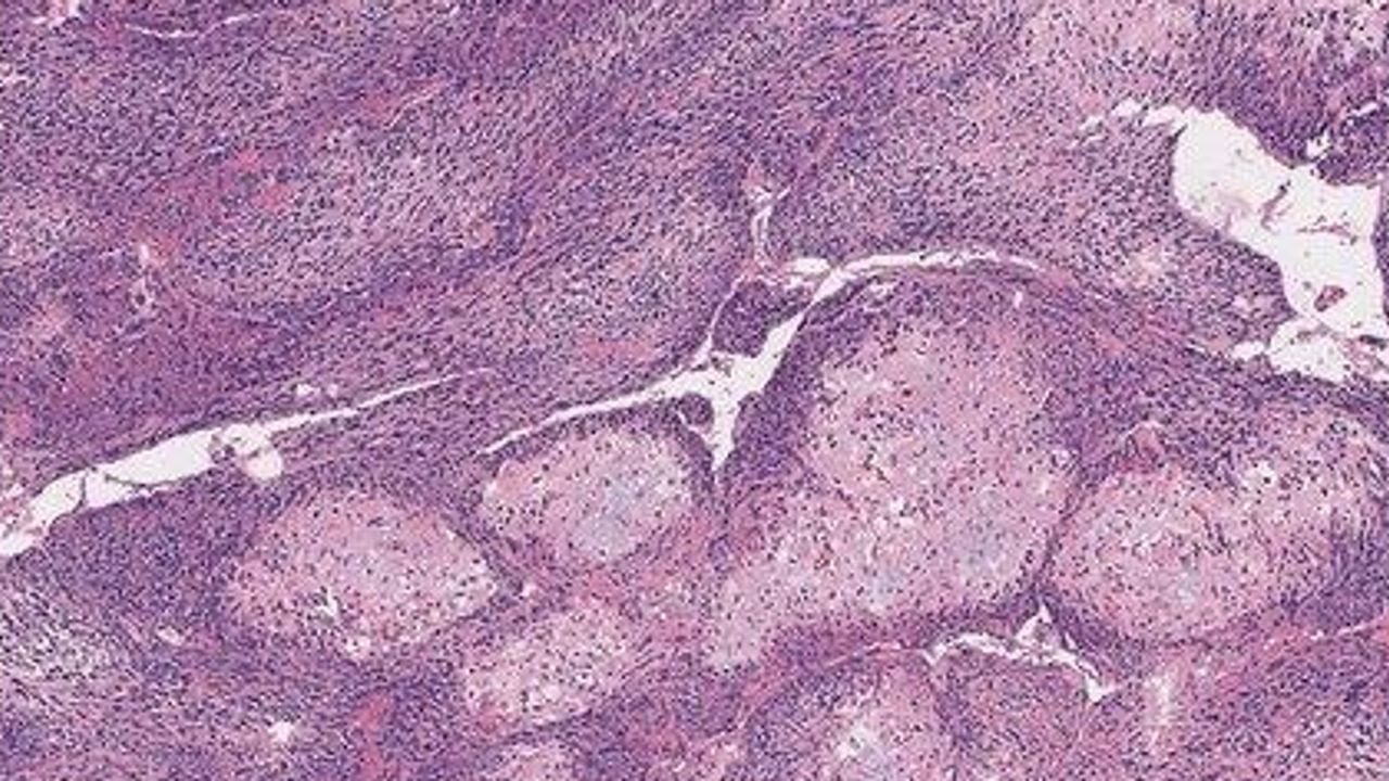 Laser Imaging May Offer New Tool for Bone Cancer Surgery