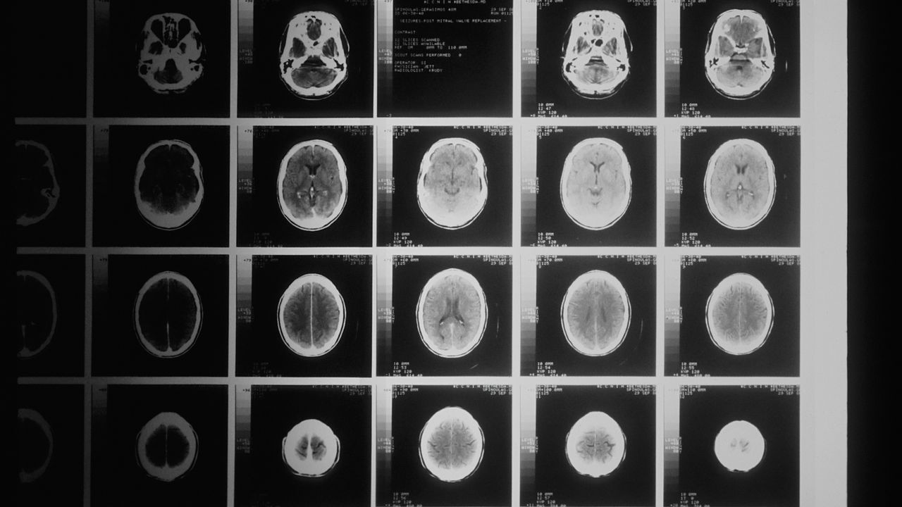 Combination of Three Existing Drugs Extends Survival of Mice With Glioblastoma
