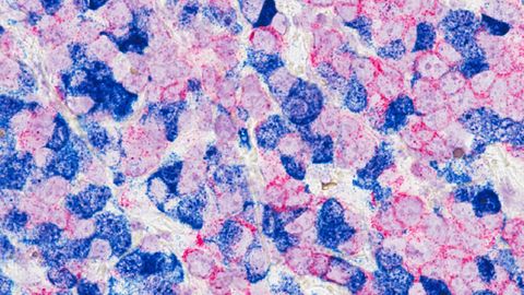 Breast Cancer Cells Identified That Control Their Ability To Spread to the Lungs