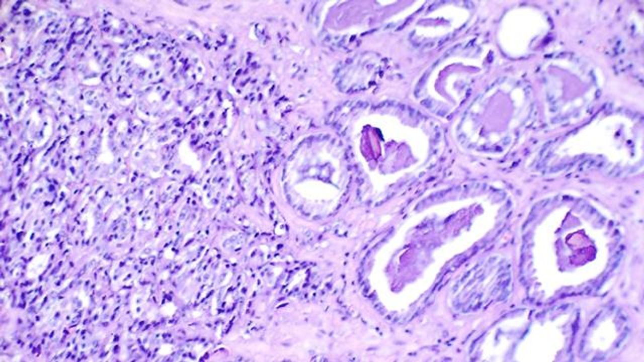 Study May Reveal the Origins of Prostate Cancers