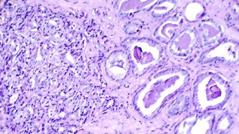 Study May Reveal the Origins of Prostate Cancers