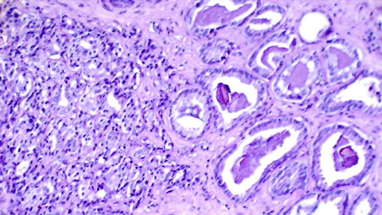 Researchers Identify Genetic Factors Associated With Drug Resistance in Prostate Cancer