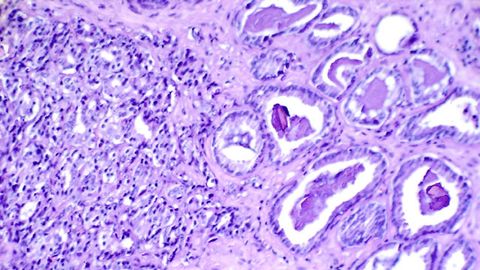 Researchers Identify Genetic Factors Associated With Drug Resistance in Prostate Cancer