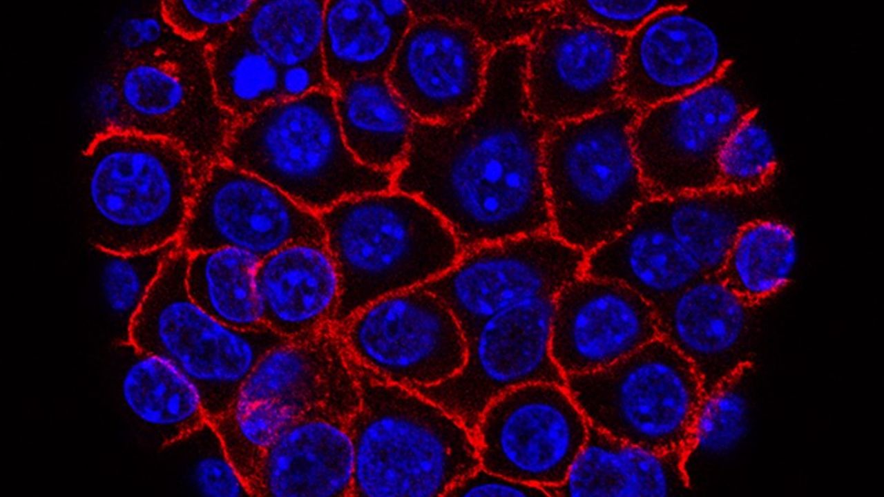 Potential Genetic Marker for Pancreatic Cancer Therapy Identified