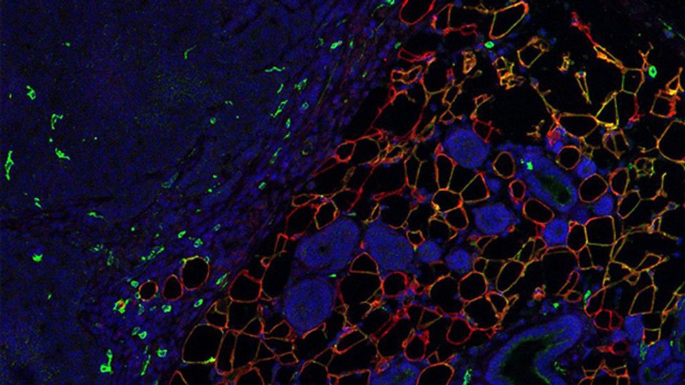 Adipose cells (shown in red) taking on a new form (shown in green) as they come in contact with a tumor (in blue).