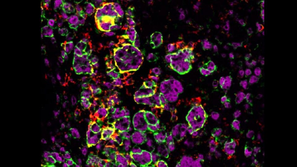 Macrophages attacking adrenal tumor in male mouse.