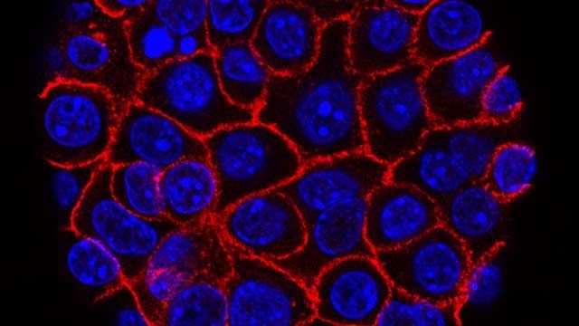 Pancreatic cancer cells under the microscope. The cell nuclei are shown in blue, and the plasma membranes in red. 