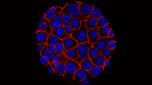 Pancreatic cancer cells with blue nuclei growing as a sphere encased in red membranes. 