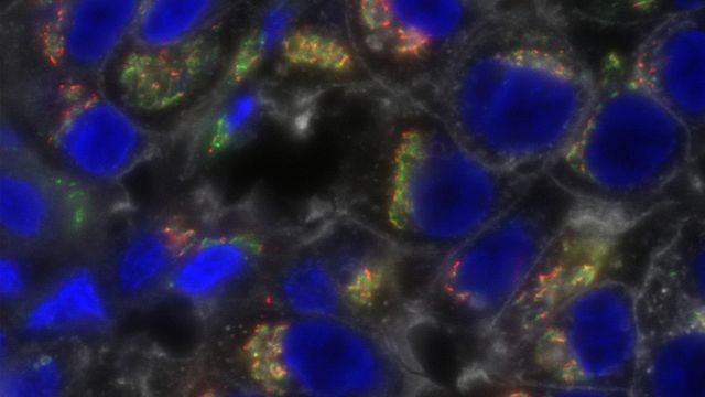 A sample of clinical triple-negative breast cancer stained for bone morphogenetic protein-11 (red); the Golgi marker GM130 (green); glycosylated proteins (white); and nuclei (blue). 