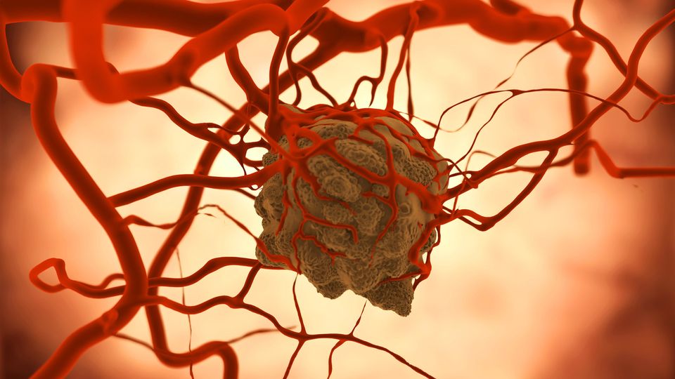 An artistic rendering of a tumor connected to blood vessels.
