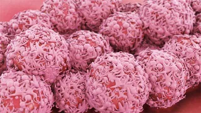 A group of cancer cells clustered together. 