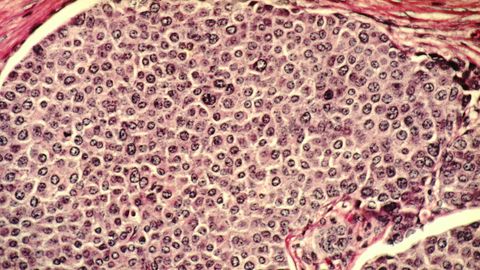 A microscope image of breast cancer cells.