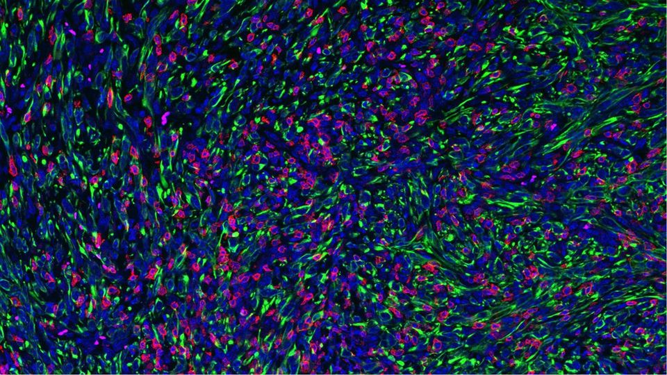 Tumor with FMRP-deficient cancer cells being infiltrated and attached by killer T cells.