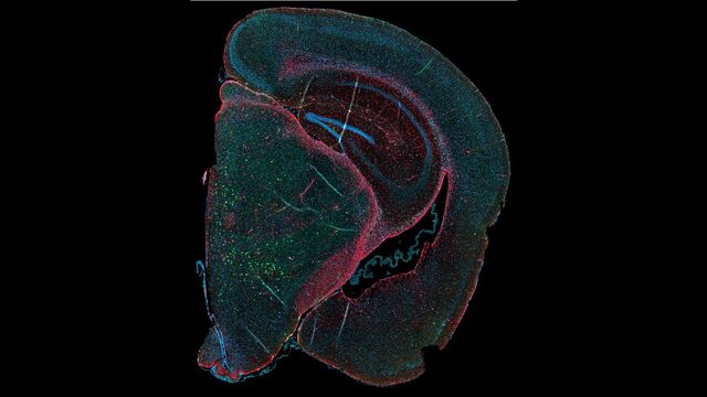 Mice expressing E46K alpha-synuclein developed neuropathological inclusions in the brain (shown in green) following injection with recombinant E46K fibrils. Red staining shows astrocytes, blue is cell nuclei.