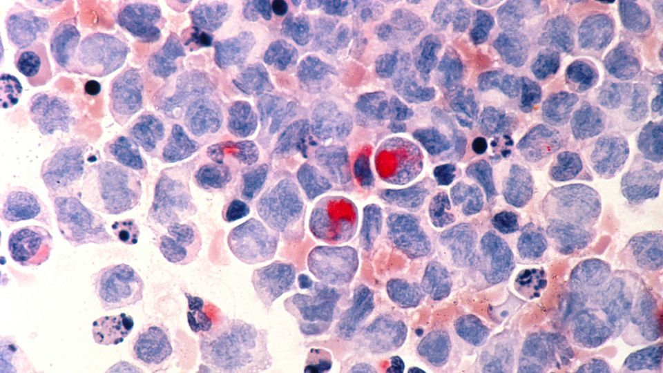 Human cells with acute myelocytic leukemia (AML) in the pericardial fluid, shown with an esterase stain at 400x.