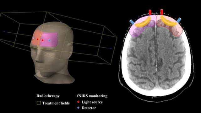 Measuring Brain Oxygenation Could Enable Personalized Cancer ...