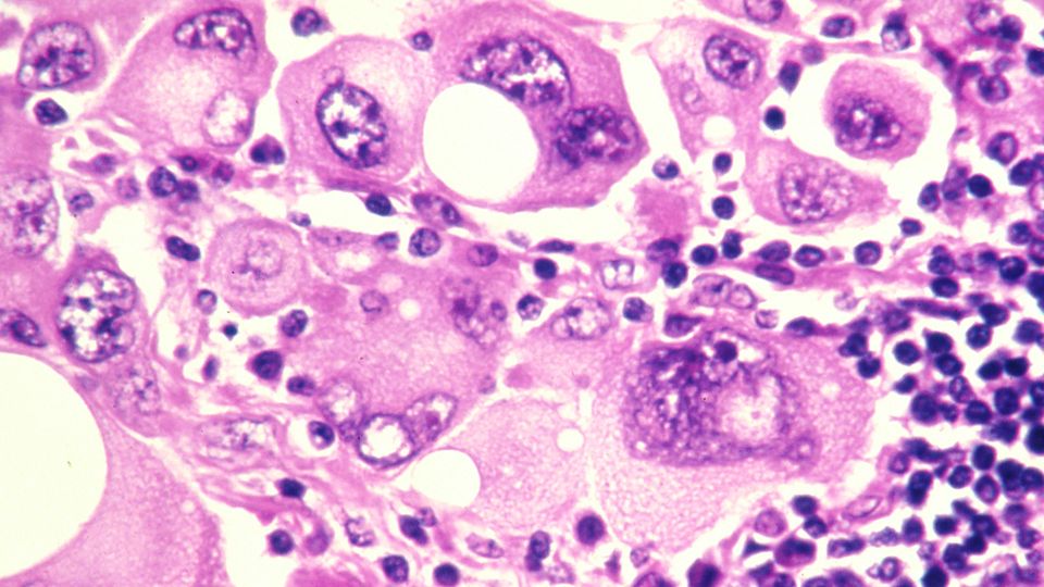 Human metastatic melanoma cells stained with an H & E stain and magnified to 320x.