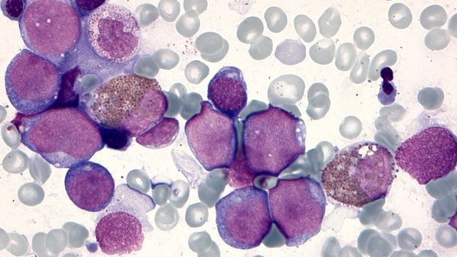 Bone marrow cells, from a child with Down syndrome and leukemia, taken under the microscope. 