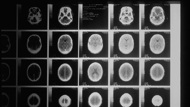 Several images taken of the brain of patient with brain cancer. 