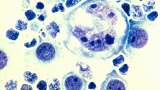 Human lymphoma tumor cells in the pleural fluid stained with a Defquick stain and magnified to 400x.  