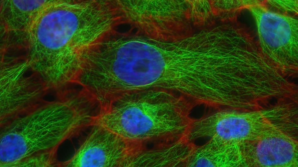 Fluorescent imaging of breast cancer cells.