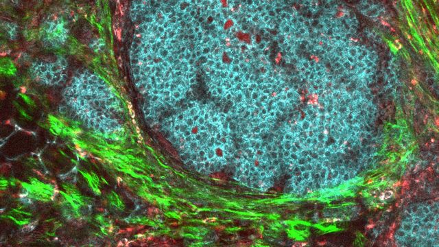 Fluorescence microscopy image of a breast cancer tumor grown within a mouse. 