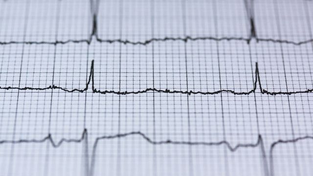 Existing Drug Shows Promise For Abnormal Heart Rhythms Technology Networks
