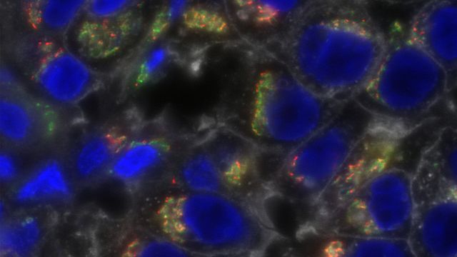 Study Uncovers Potential Mechanism of New Triple-Negative Breast Cancer ...