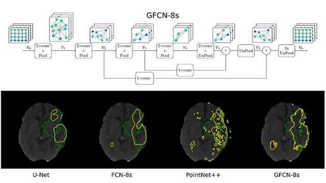 Deep Learning Model Can Detect Stroke Lesions More Accurately - Image