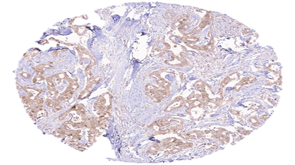 Immunohistochemistry on a human breast cancer tissue microarray.