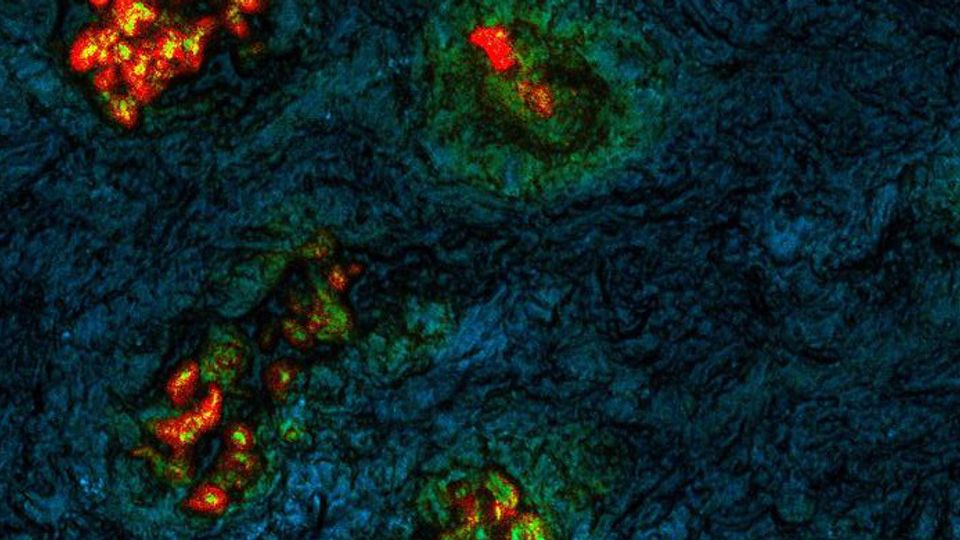 Clusters of colorectal cancer cells metastasized to the liver, resected from a patient.