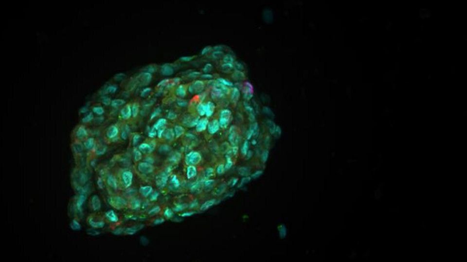 Organoid model of a tumor.