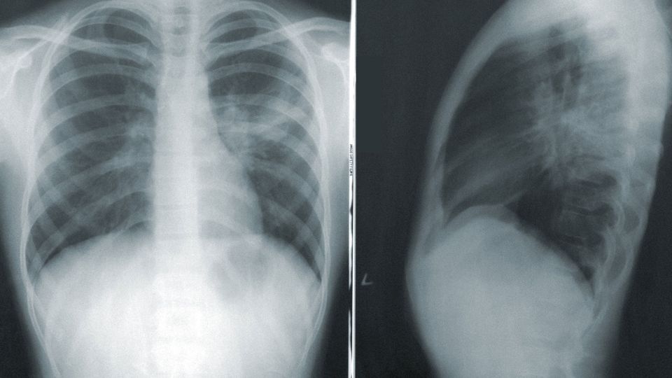 An X-ray image of lungs.