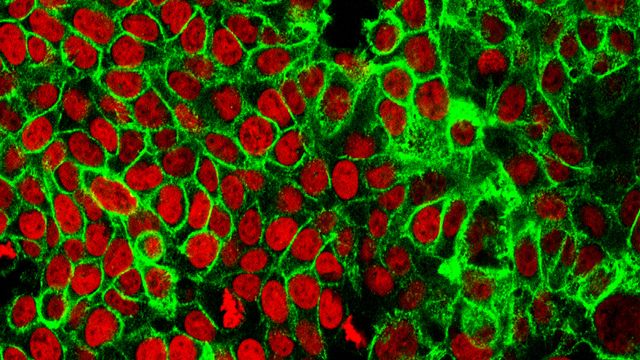 Human colon cancer cells.