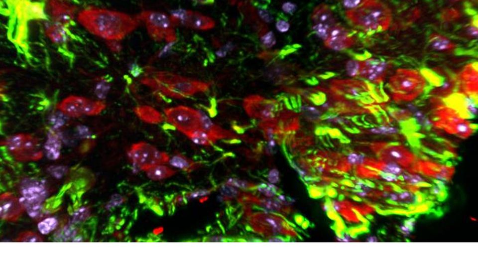 In vivo overexpression of Snail (Red) in microglia/macrophage cells in injured cortex.