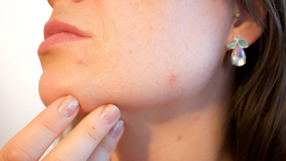 A close up of someone with acne on their chin.