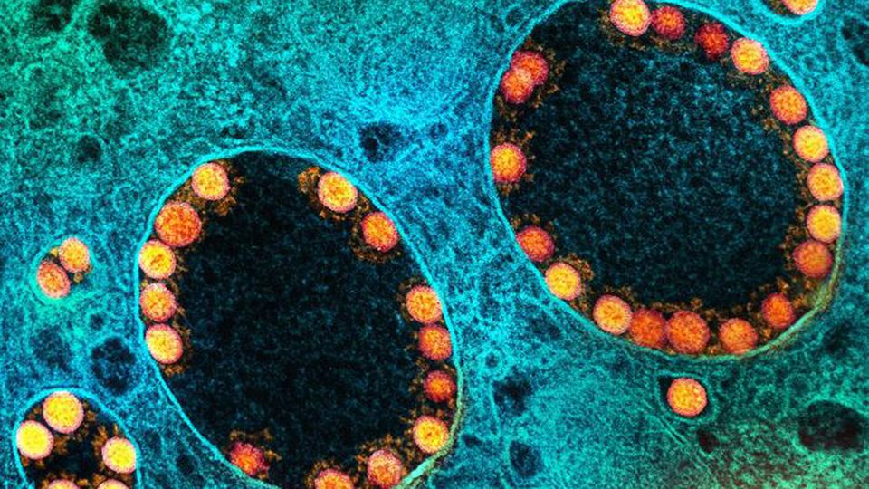 Transmission electron micrograph of SARS-CoV-2 virus particles (orange) within endosomes of a heavily infected nasal Olfactory Epithelial Cell.