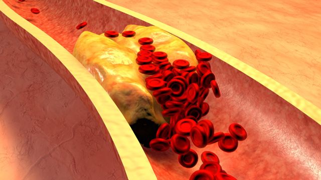 Kupffer Cells in Atherosclerosis
