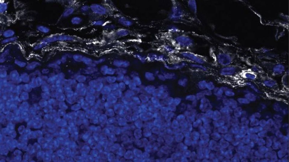 Blue cells are surrounded by a layer of white fibrotic collagen.